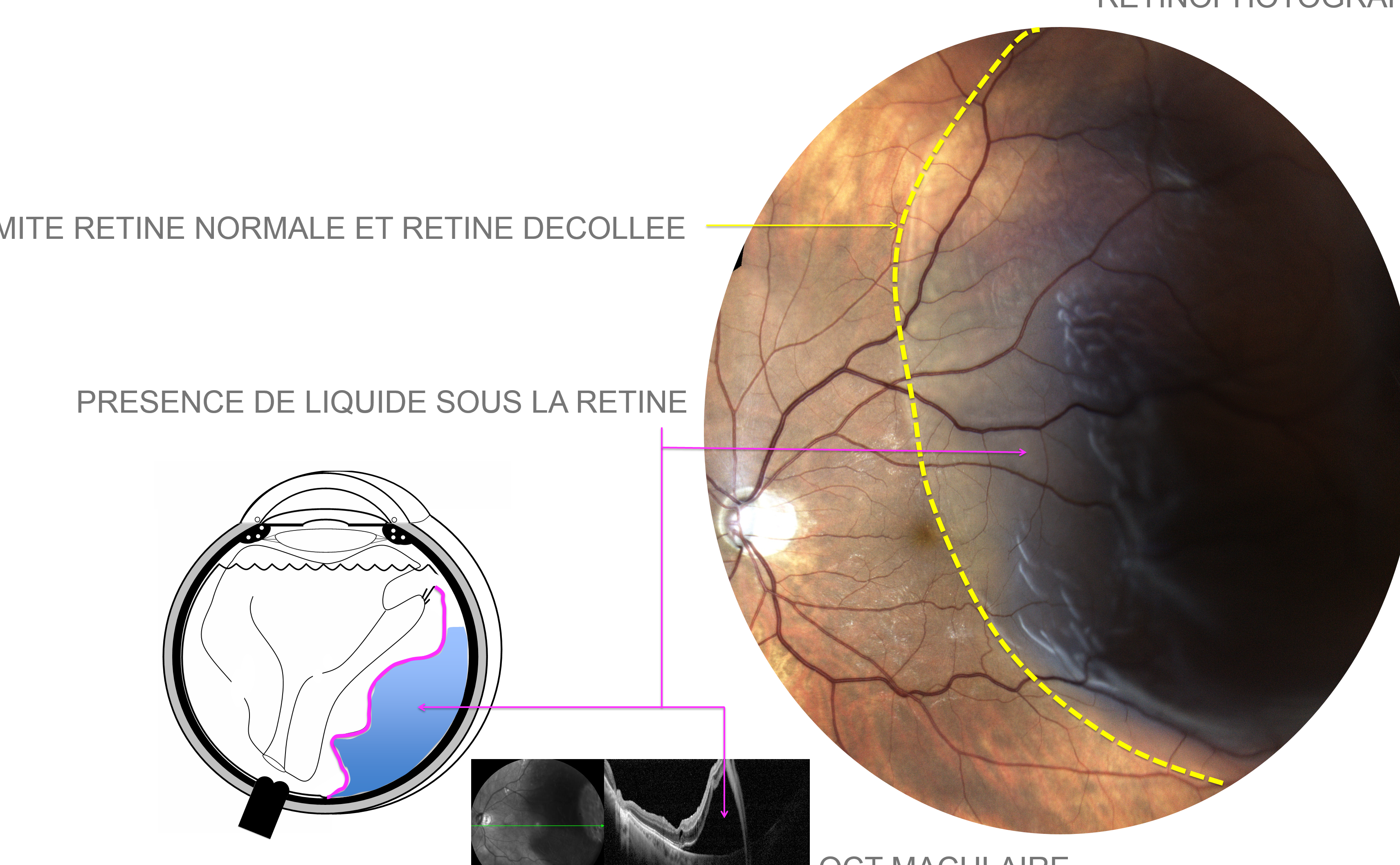 Comment Reconna tre Les Signes D un D collement De R tine Rhegmatog ne Comment Reconna tre Les Signes D un D collement De R tine Rhegmatog ne